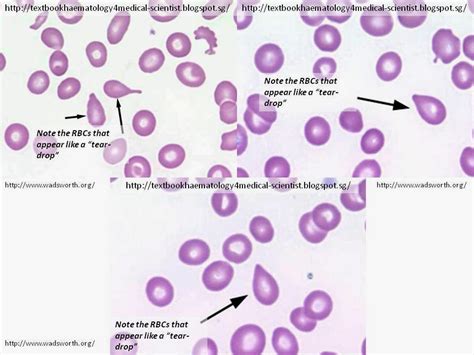 tear drop test|What is the significance of teardrop cells (dacrocytes) .